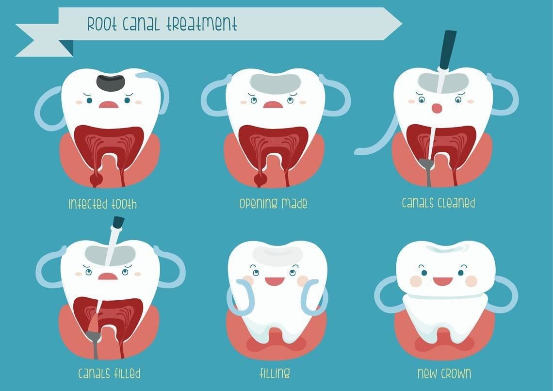 Root canal treatment