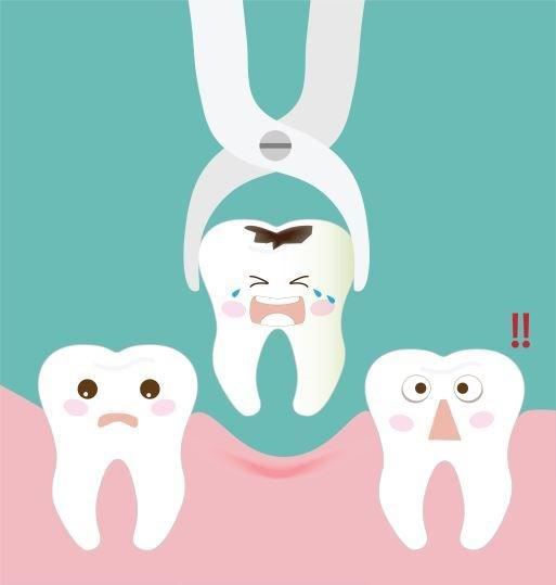 Tooth Removal